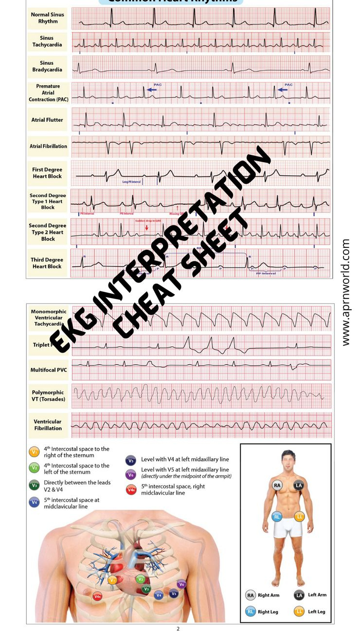 Ekg Interpretation Cheat Sheet - 12 Pages with Free Printable Ekg Interpretation Cheat Sheet