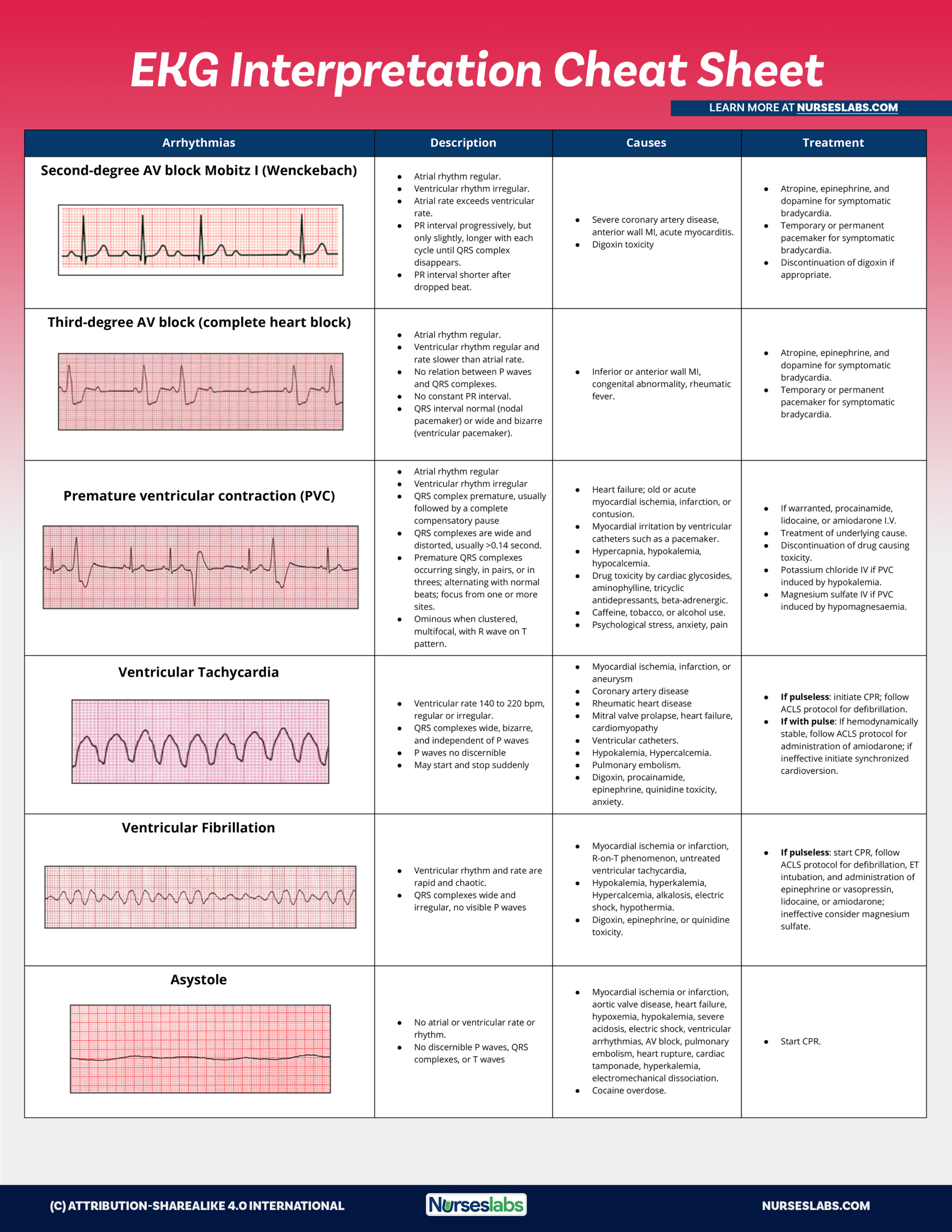 Ekg Interpretation Cheat Sheet &Amp; Heart Arrhythmias Guide (2020 for Free Printable Ekg Interpretation Cheat Sheet